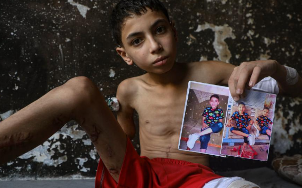 以军空袭造成的巴勒斯坦残疾儿童